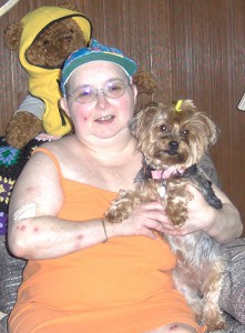 Stories of Hope Mollys Fund Fighting Lupus